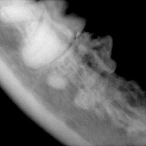  Рентген нижней челюсти