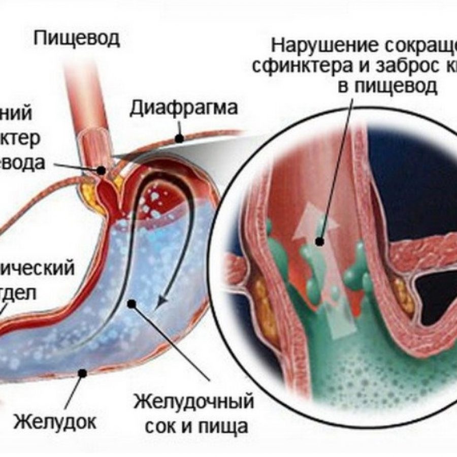 Рефлюкс-эзофагит, синдром Золлингера